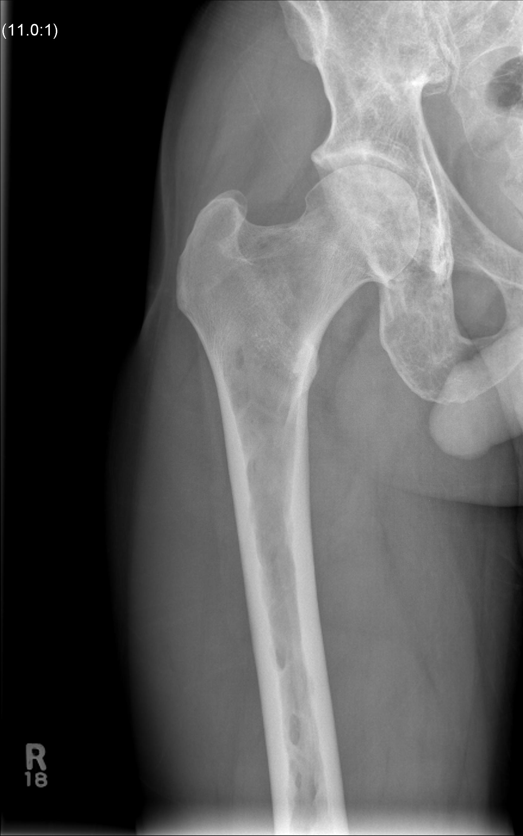 Multiple Myeloma Pelvis0001